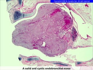 A solid and cystic endobronchial masa 