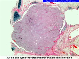 A solid and cystic endobronchial masa with focal calcification 