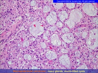 Mucoepidermoid carcinoma  ; many glands, mucin-filled cysts 