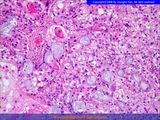 Mucoepidermoid carcinoma 