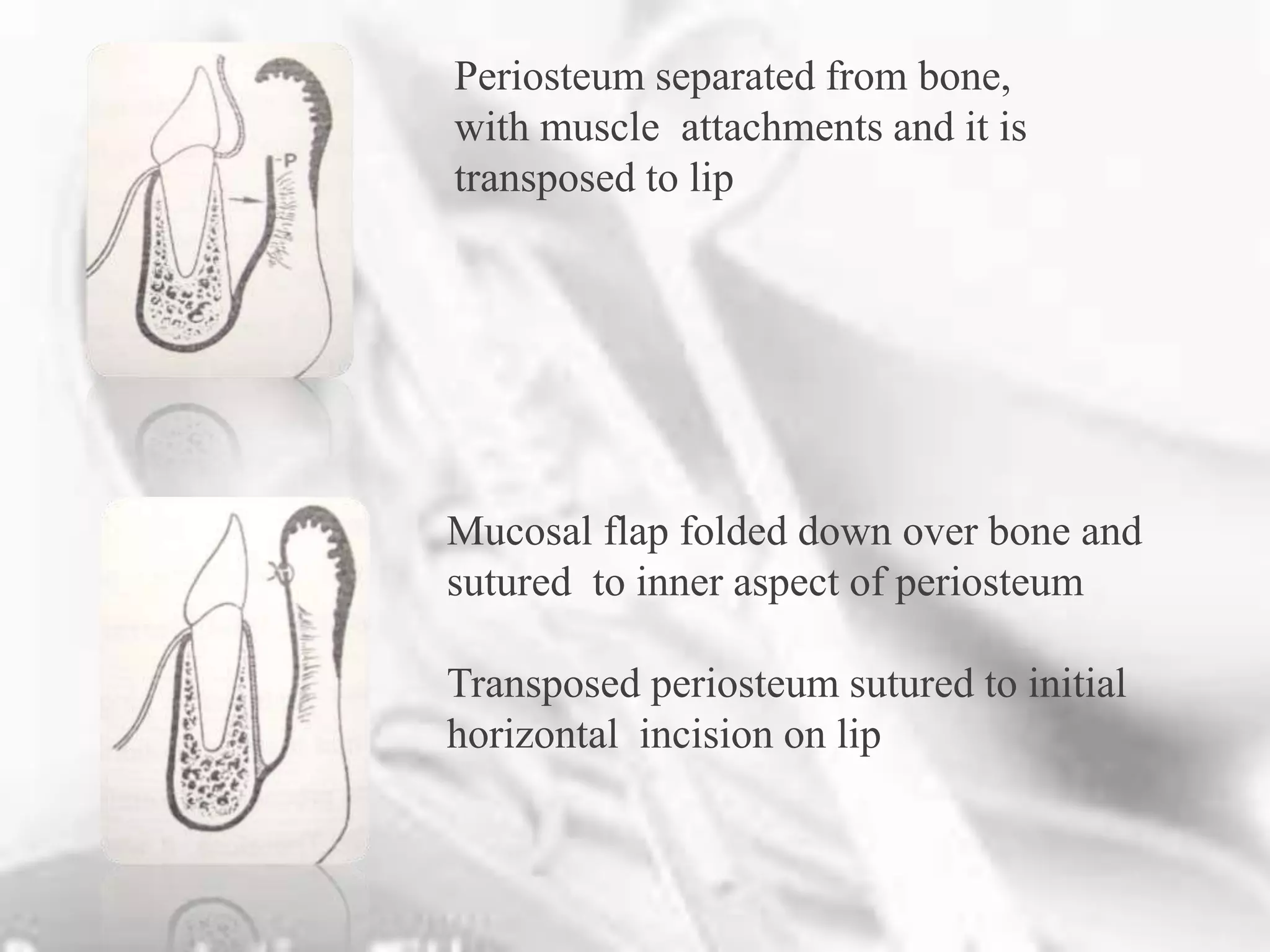 Mucogingival surgeries other than soft tissue grafts | PPT