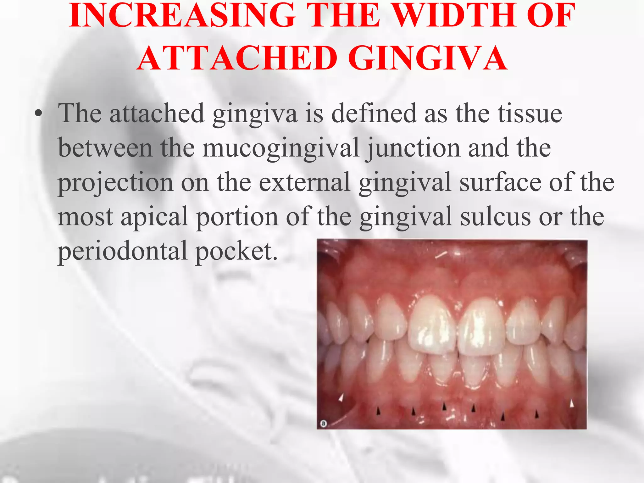 Mucogingival surgeries other than soft tissue grafts | PPT
