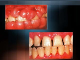 En relación con el hueso, la pérdida de alturaque se produce después de un remodelado, exposición o trauma:0.54 y 0.98 mm* Cuantomasancho y esponjoso sea  el hueso, menorpérdida se producirá