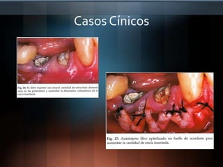 Perforaciónradicular2)  Alteraciones de la Erupción   -  Supraerupción              -  Erupciónpasivaalterada3) Combinación de dos aparatos4) Clínicacortaporhiperplasia gingival