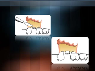 Colgajo de Reposición Apical