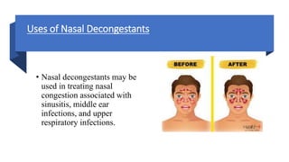Uses of Nasal Decongestants
• Nasal decongestants may be
used in treating nasal
congestion associated with
sinusitis, middle ear
infections, and upper
respiratory infections.
 
