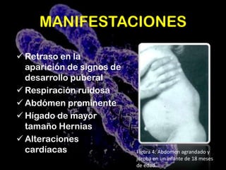 Cuando una persona solamente recibe un gen defectuoso de MPS, será portador. 6   Excepciones Enfermedad de Hunter su patrón de herencia esta ligada al cromosoma sexual X.Figura 1: rasgos fenotipo de enfermedad de Hunter