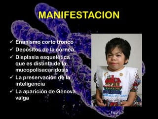 Alteraciones cardíacasFigura 4: Abdomen agrandado y joroba en un infante de 18 meses de edad.