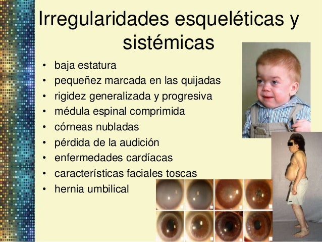 Mucopolisacaridosis Mucopolisacaridosis
