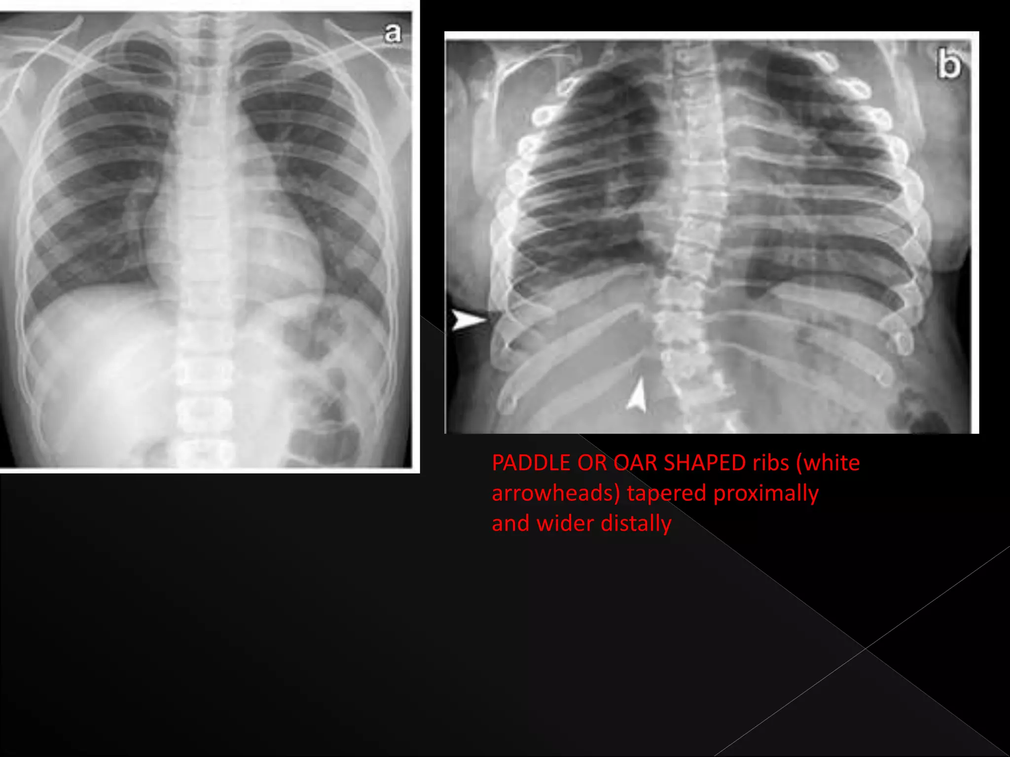 Mps Radiology radiological features of Mucopolysaccharidoses | PPTX