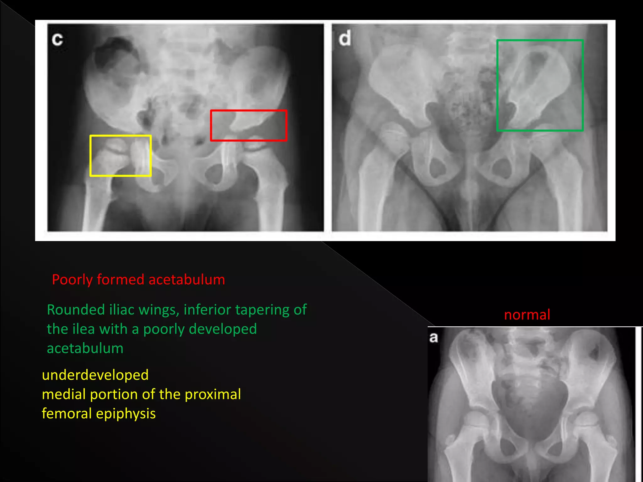 Mps Radiology radiological features of Mucopolysaccharidoses | PPTX