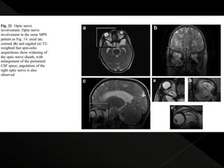 Mps Radiology radiological features of Mucopolysaccharidoses | PPTX