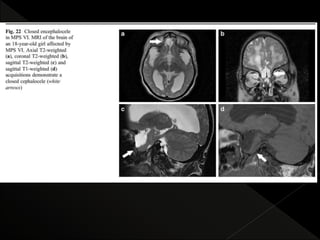 Mps Radiology radiological features of Mucopolysaccharidoses | PPTX