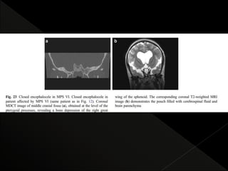 Mps Radiology radiological features of Mucopolysaccharidoses | PPTX