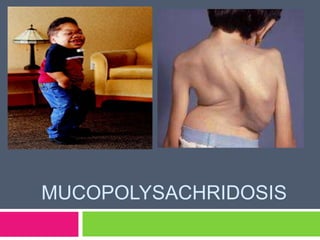 MUCOPOLYSACHRIDOSIS
 