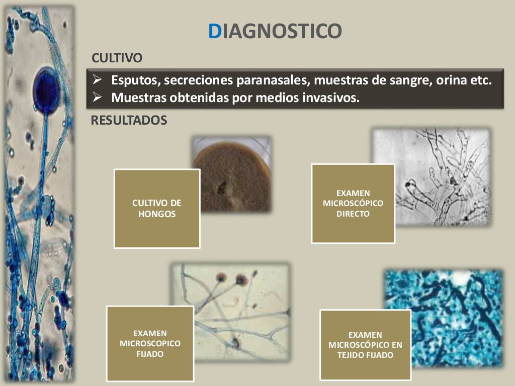 Mucormicosis Mucormicosis rinocerebralcutánea en paciente diabético