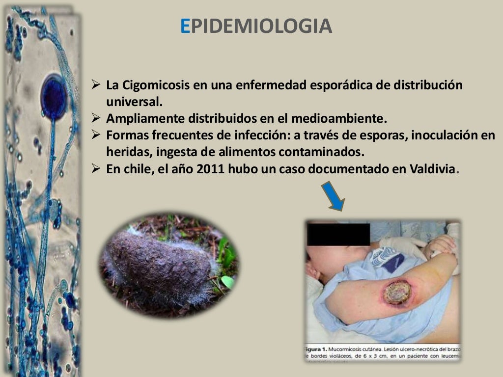 Mucormicosis Mucormicosis rinocerebralcutánea en paciente diabético
