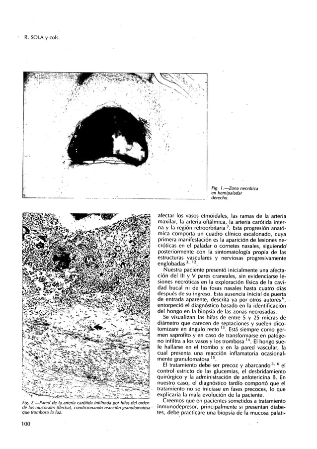 Mucormicosis rinocerebral en paciente con transplante renal