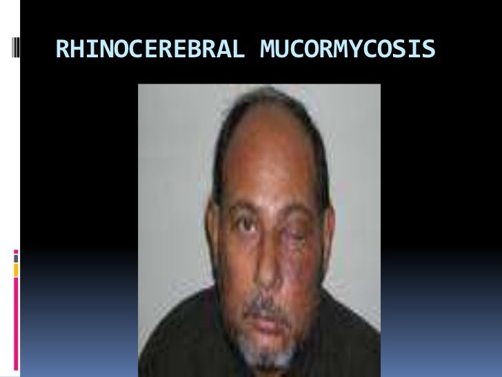 RHINOCEREBRAL MUCORMYCOSIS EBOOK RHINOCEREBRAL MUCORMYCOSIS EBOOK