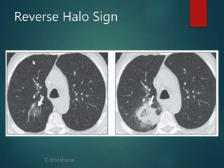 ©drseshasai
Reverse Halo Sign
 
