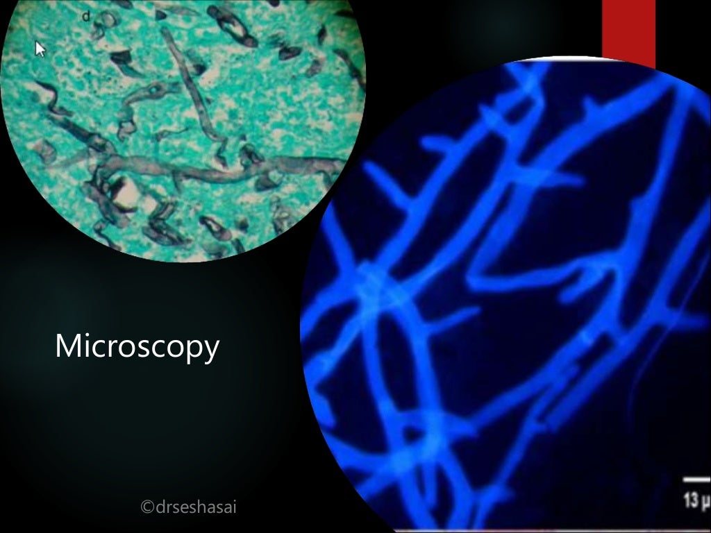 Mucormycosis