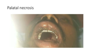 Palatal necrosis
 