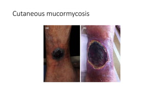 Cutaneous mucormycosis
 