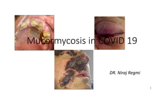 Mucormycosis in COVID 19
1
DR. Niraj Regmi
 