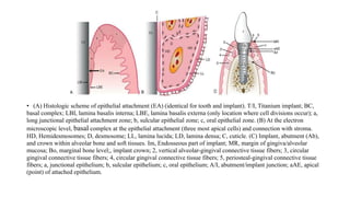 • (A) Histologic scheme of epithelial attachment (EA) (identical for tooth and implant). T/I, Titanium implant; BC,
basal complex; LBI, lamina basalis interna; LBE, lamina basalis externa (only location where cell divisions occur); a,
long junctional epithelial attachment zone; b, sulcular epithelial zone; c, oral epithelial zone. (B) At the electron
microscopic level, basal complex at the epithelial attachment (three most apical cells) and connection with stroma.
HD, Hemidesmosomes; D, desmosome; LL, lamina lucida; LD, lamina densa; C, cuticle. (C) Implant, abutment (Ab),
and crown within alveolar bone and soft tissues. Im, Endosseous part of implant; MR, margin of gingiva/alveolar
mucosa; Bo, marginal bone level;, implant crown; 2, vertical alveolar-gingival connective tissue fibers; 3, circular
gingival connective tissue fibers; 4, circular gingival connective tissue fibers; 5, periosteal-gingival connective tissue
fibers; a, junctional epithelium; b, sulcular epithelium; c, oral epithelium; A/I, abutment/implant junction; aAE, apical
(point) of attached epithelium.
 