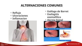 Esofagatis MUCOSA ESOFAGICA principales factores.pptx