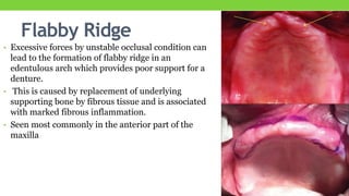 Mucosal response to oral prosthesis | PPTX