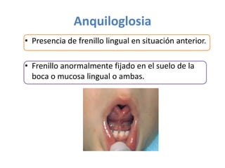 Anquiloglosia
• Presencia de frenillo lingual en situación anterior.
• Frenillo anormalmente fijado en el suelo de la
boca o mucosa lingual o ambas.

 