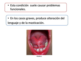 • Esta condición suele causar problemas
funcionales.
• En los casos graves, produce alteración del
lenguaje y de la masticación.

 