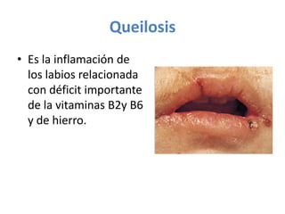 Queilosis
• Es la inflamación de
los labios relacionada
con déficit importante
de la vitaminas B2y B6
y de hierro.

 