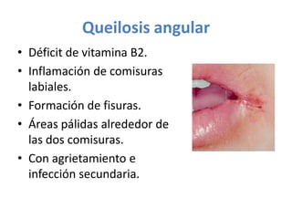 Queilosis angular
• Déficit de vitamina B2.
• Inflamación de comisuras
labiales.
• Formación de fisuras.
• Áreas pálidas alrededor de
las dos comisuras.
• Con agrietamiento e
infección secundaria.

 