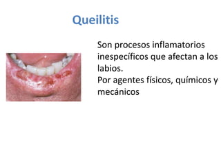 Queilitis
Son procesos inflamatorios
inespecíficos que afectan a los
labios.
Por agentes físicos, químicos y
mecánicos

 