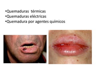 •Quemaduras térmicas
•Quemaduras eléctricas
•Quemadura por agentes químicos

 
