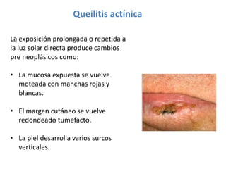 Queilitis actínica
La exposición prolongada o repetida a
la luz solar directa produce cambios
pre neoplásicos como:
• La mucosa expuesta se vuelve
moteada con manchas rojas y
blancas.
• El margen cutáneo se vuelve
redondeado tumefacto.

• La piel desarrolla varios surcos
verticales.

 