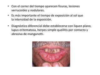 • Con el correr del tiempo aparecen fisuras, lesiones
verrucoides y nodulares.
• Es más importante el tiempo de exposición al sol que
la intensidad de la exposición.
• Diagnóstico diferencial debe establecerse con liquen plano,
lupus eritematosa, herpes simple queilitis por contacto y
abrasiva de manganotti.

 