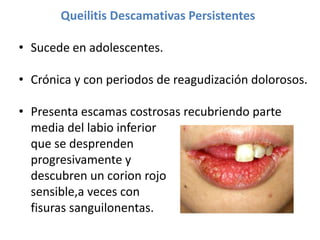 Queilitis Descamativas Persistentes
• Sucede en adolescentes.

• Crónica y con periodos de reagudización dolorosos.
• Presenta escamas costrosas recubriendo parte
media del labio inferior
que se desprenden
progresivamente y
descubren un corion rojo
sensible,a veces con
fisuras sanguilonentas.

 
