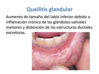 Queilitis glandular
Aumento de tamaño del labio inferior debido a
inflamación crónica de las glándulas salivales
menores y distención de las estructuras ductales
excretoras.

 