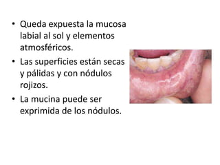 • Queda expuesta la mucosa
labial al sol y elementos
atmosféricos.
• Las superficies están secas
y pálidas y con nódulos
rojizos.
• La mucina puede ser
exprimida de los nódulos.

 