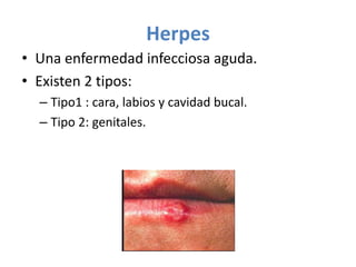 Herpes
• Una enfermedad infecciosa aguda.
• Existen 2 tipos:
– Tipo1 : cara, labios y cavidad bucal.
– Tipo 2: genitales.

 