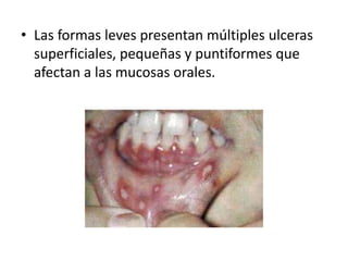 • Las formas leves presentan múltiples ulceras
superficiales, pequeñas y puntiformes que
afectan a las mucosas orales.

 