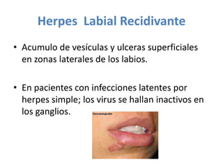 Herpes Labial Recidivante
• Acumulo de vesículas y ulceras superficiales
en zonas laterales de los labios.
• En pacientes con infecciones latentes por
herpes simple; los virus se hallan inactivos en
los ganglios.

 