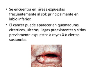 • Se encuentra en áreas expuestas
frecuentemente al sol: principalmente en
labio inferior.
• El cáncer puede aparecer en quemaduras,
cicatrices, úlceras, llagas preexistentes y sitios
previamente expuestos a rayos X o ciertas
sustancias.

 