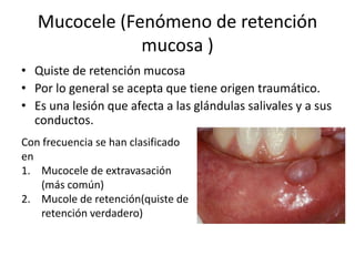Mucocele (Fenómeno de retención
mucosa )
• Quiste de retención mucosa
• Por lo general se acepta que tiene origen traumático.
• Es una lesión que afecta a las glándulas salivales y a sus
conductos.
Con frecuencia se han clasificado
en
1. Mucocele de extravasación
(más común)
2. Mucole de retención(quiste de
retención verdadero)

 