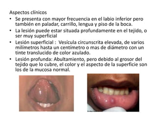 Aspectos clínicos
• Se presenta con mayor frecuencia en el labio inferior pero
también en paladar, carrillo, lengua y piso de la boca.
• La lesión puede estar situada profundamente en el tejido, o
ser muy superficial
• Lesión superficial : Vesícula circunscrita elevada, de varios
milímetros hasta un centímetro o mas de diámetro con un
tinte translucido de color azulado.
• Lesión profunda: Abultamiento, pero debido al grosor del
tejido que lo cubre, el color y el aspecto de la superficie son
los de la mucosa normal.

 