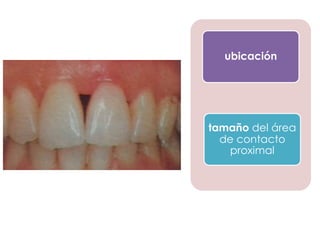 ubicación

tamaño del área
de contacto
proximal

 