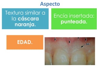 Aspecto
Textura similar a
la cáscara
naranja.
EDAD.

Encía insertada:
punteada.

 